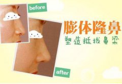 膨體隆鼻后期果怎么樣呢?果圖有嗎？