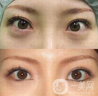 開(kāi)眼角手術(shù)術(shù)前檢查什么？