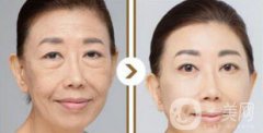 塑美極果怎么樣？塑美極的副作用