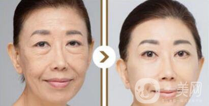 塑美極*果怎么樣？塑美極的副作用