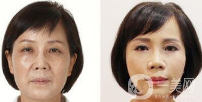 塑美極*果怎么樣？塑美極的副作用