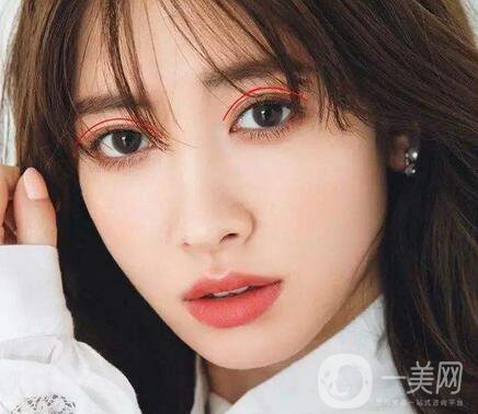 焊接雙眼皮是什么？多久能好？