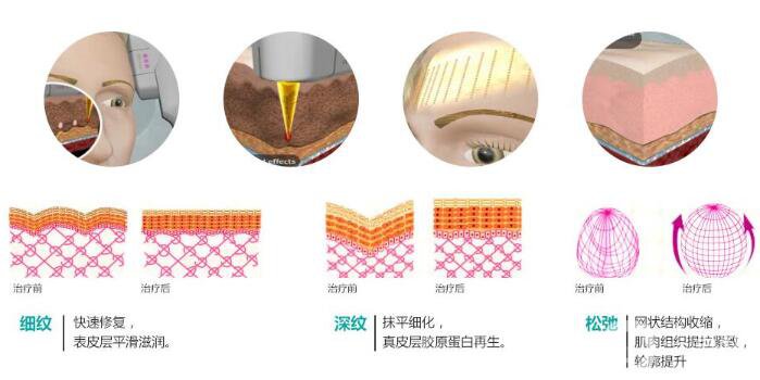 彩光嫩膚有用嗎 術(shù)后護(hù)理簡析