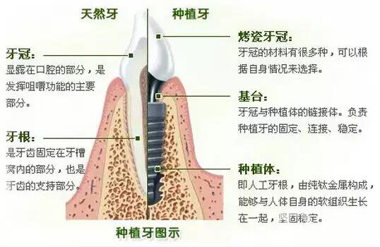 昆山種植牙價格要多少錢