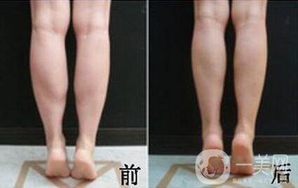 *注射瘦小腿*果怎么樣？