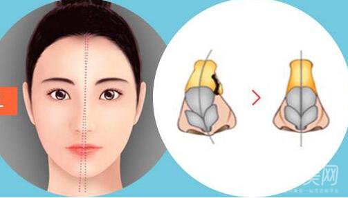 歪鼻矯正手術(shù)多少錢？