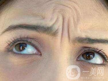 抬頭紋能消除嗎？有哪些方法？
