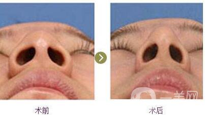 廣東,縮小鼻翼手術,需要多少錢
