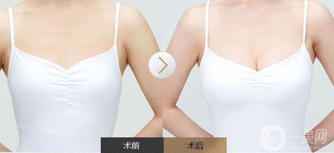 豐胸手術,缺點