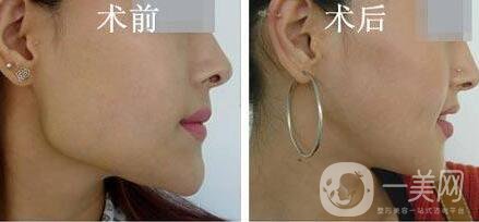 磨骨多少錢？磨骨價格盤點！