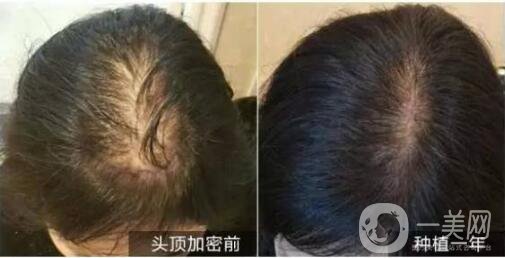 北京做植發(fā)手術(shù)哪里*果好？