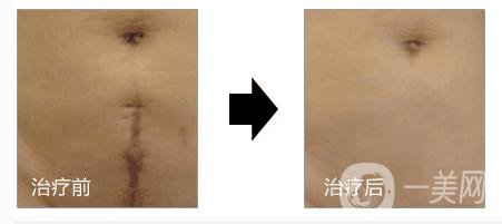 上海做一次像素激光去疤痕手術(shù)調(diào)節(jié)多少錢(qián)