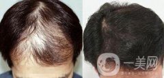鄭州植發(fā)醫(yī)院信息介紹？植發(fā)去介紹