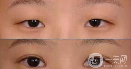 開(kāi)眼角割雙眼皮整形手術(shù)*果怎么樣