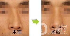 歪鼻矯正需要恢復(fù)多久？術(shù)后需要注意什么