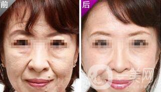 小切口面部提升*果怎么樣？會不會留疤