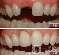 種植牙有什么優(yōu)點？北京種植牙介紹?