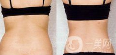 后背吸脂后多久消腫？吸脂術后如何護理