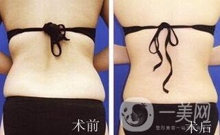 后背吸脂后多久消腫？吸脂術(shù)后如何護理