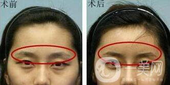 假體豐眉弓術(shù)后處理 怎么進行術(shù)后護理