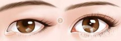 開眼角幾天恢復(fù)？開眼角手術(shù)費用介紹