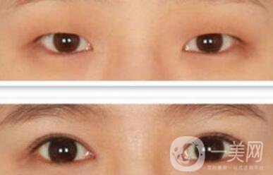 開眼角幾天恢復？開眼角手術費用介紹