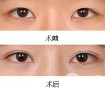 雙眼皮增生了怎么處理？雙眼皮修復(fù)價格多少
