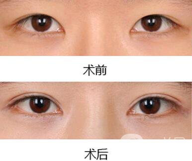 雙眼皮增生了怎么處理？雙眼皮修復價格多少