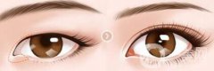 開眼角術(shù)后注意事項(xiàng)具體有哪些