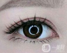 雙眼皮埋線前注意什么？