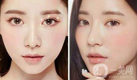 雙眼皮拆線后怎么護(hù)理？