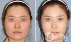 去頰脂墊瘦臉術(shù)后護(hù)理怎么做？