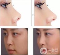 鼻小柱延長(zhǎng)恢復(fù)過(guò)程是怎樣的