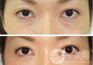 激光去眼袋手術后如何護理 要注意些什么