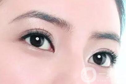 割雙眼皮痕跡多久消失？