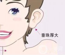 上海玻尿酸豐耳垂術要多少錢