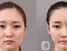 顴骨手術(shù)多長時(shí)間恢復(fù)？