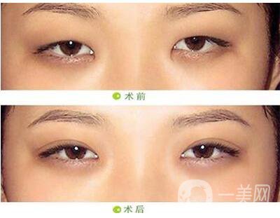 開眼角,開眼角手術過程,上海開眼角手術過程