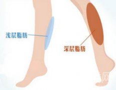 小腿吸脂手術(shù)后多久會明X變瘦