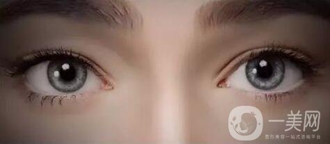 開眼角手術價格是多少？