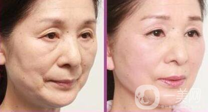 冰點拉皮*果怎么樣？