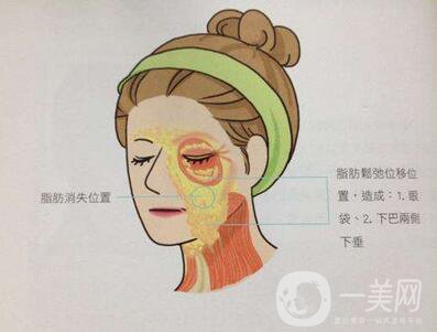 電波拉皮除皺*果好嗎？
