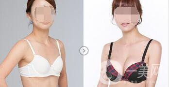 假體豐胸術后注意事項詳細介紹