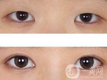 開眼角眼睛變化大嗎？