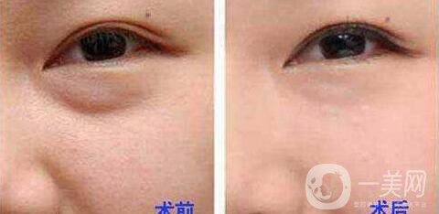電波拉皮去眼袋*果怎么樣？