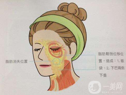 冰電波拉皮好嗎？冰電波拉皮優(yōu)勢(shì)！
