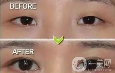 開(kāi)眼角多少錢,成都開(kāi)眼角多少錢