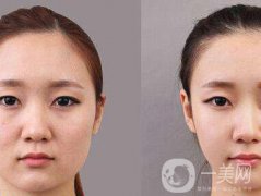顴骨肉怎么消？怎么縮小顴骨？