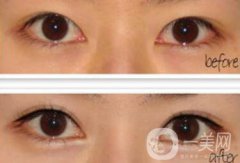 廣州開眼角的費用是多少