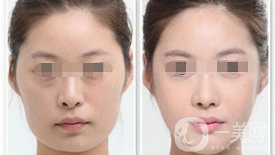 做過顴骨和下顎角手術后的感受